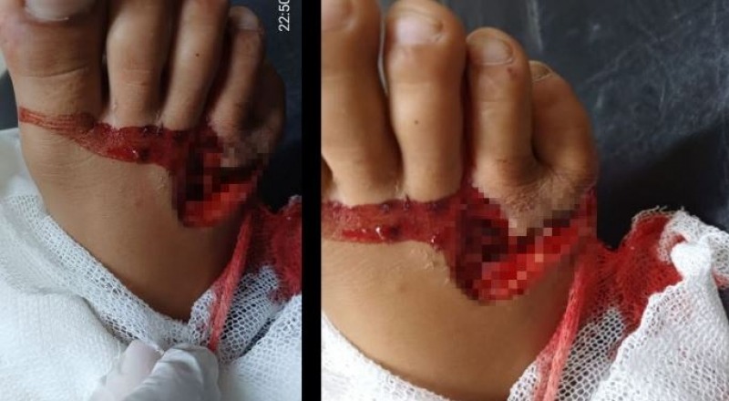 Un perro mordi� a un ni�o y le caus� graves lesiones